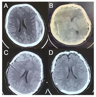 Cryptogenic recurrent spontaneous intracranial epidural hematoma: A case report and literature review